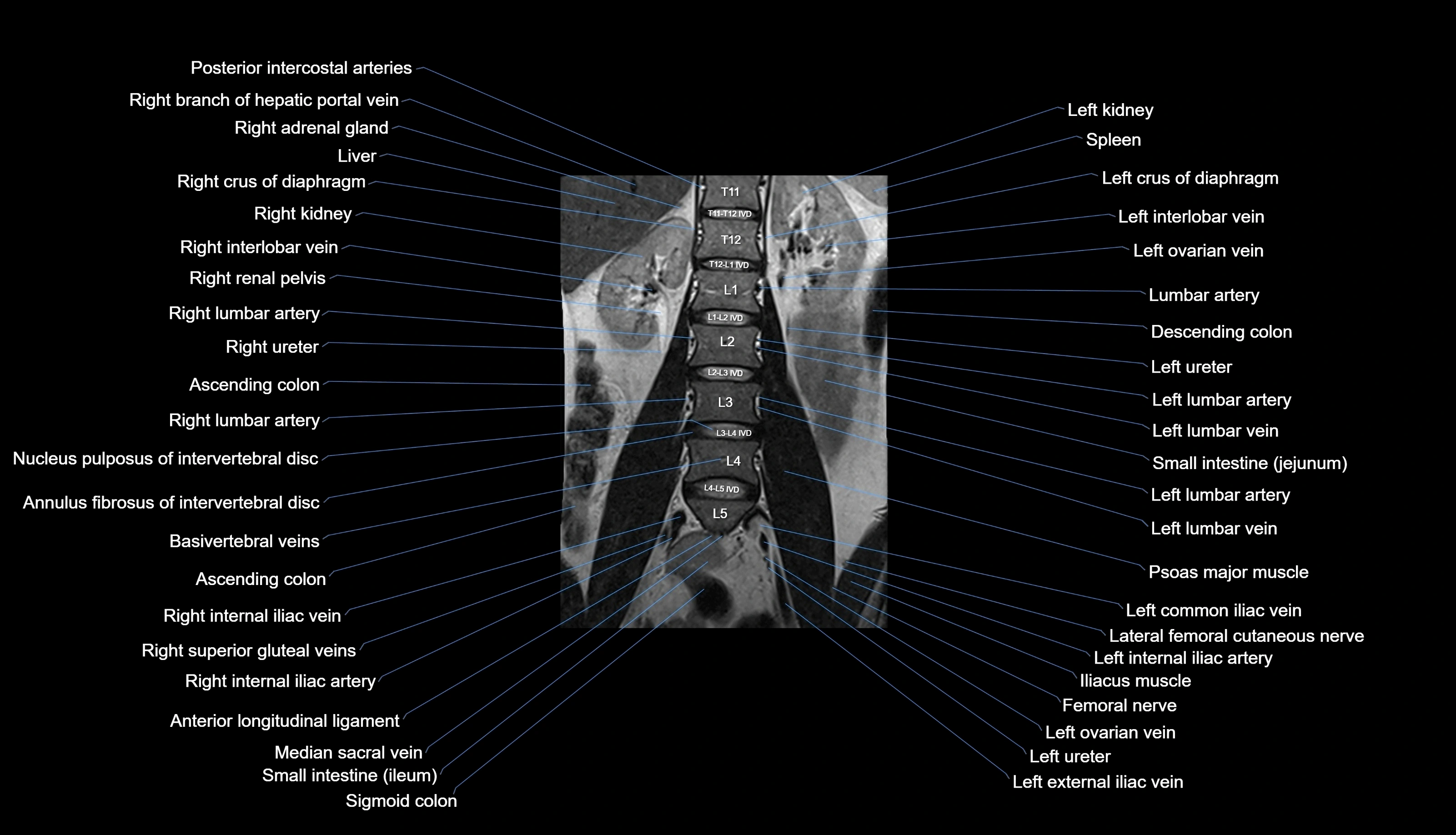 MRI lumbar spine labelled coronal cross sectional anatomy 3T radiology-img-00001-00012.webp